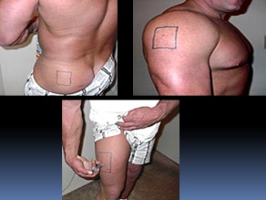Injection spots for steroids