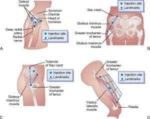 testosterone-injection-sites-300x238.jpg