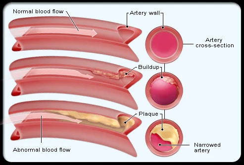 Name: cholesterol_drugs_s2_cholesterol_illustration - Copy.jpg Views: 271 Size: 62.1 KB