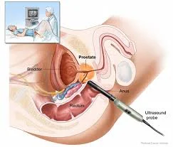 Name: prostateultrasound.jpg Views: 4655 Size: 8.2 KB