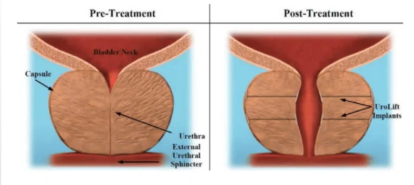 eurolift BPH Treatment.webp