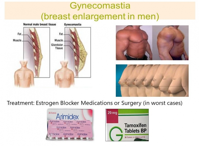 gynecomastia_hormone_causes.jpg