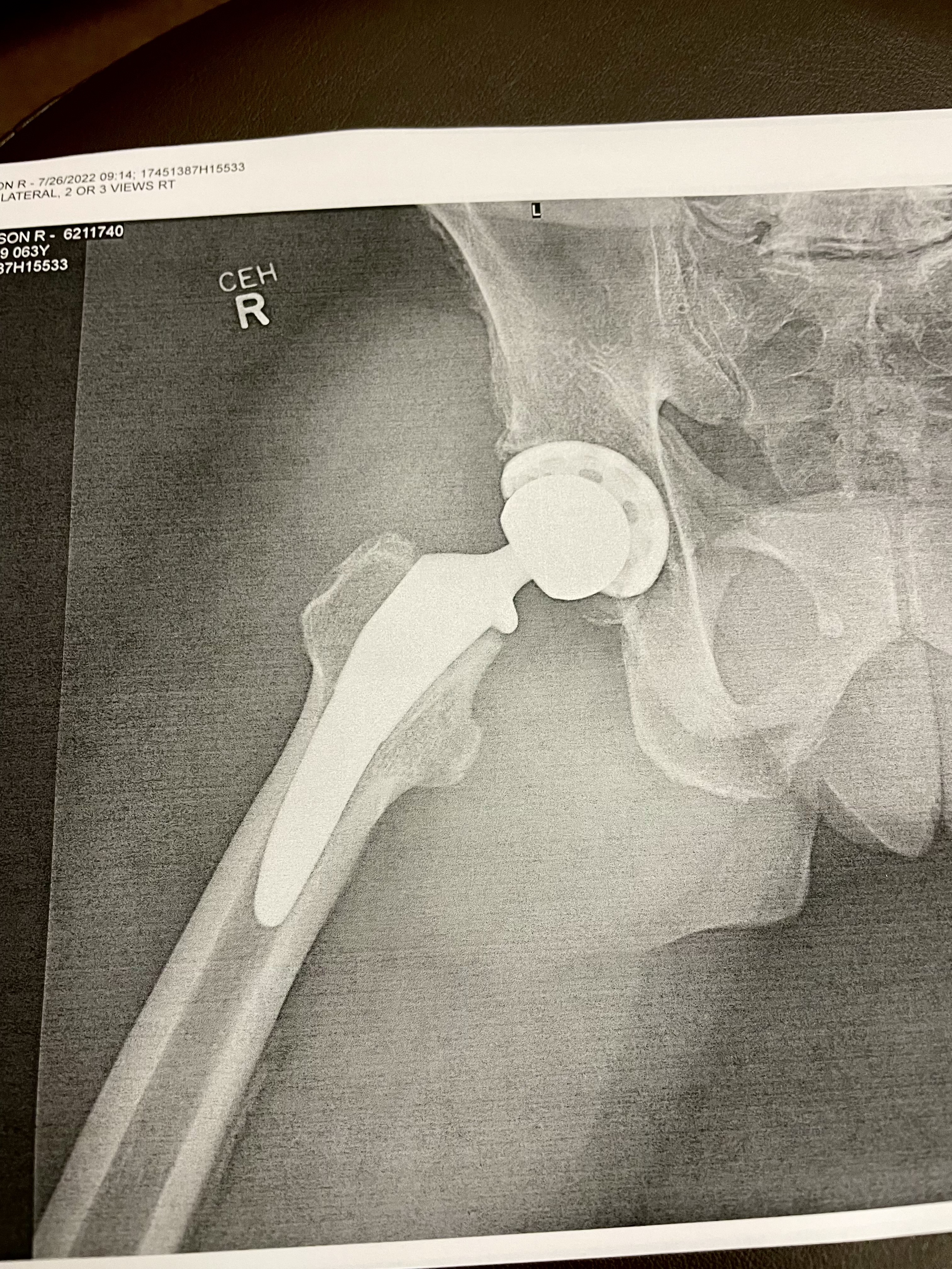 hip replacement X rays.JPG