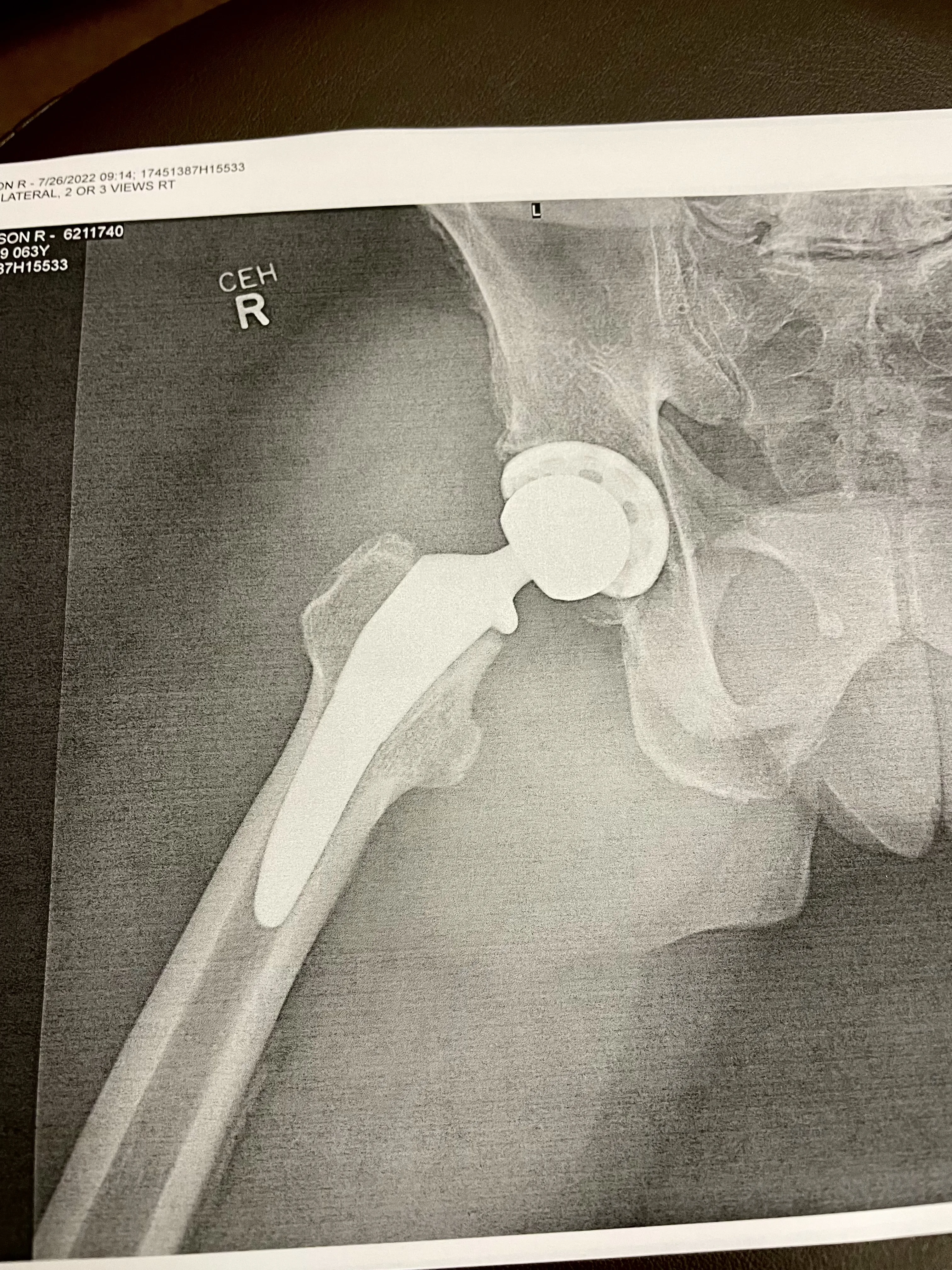 hip replacement X rays.webp