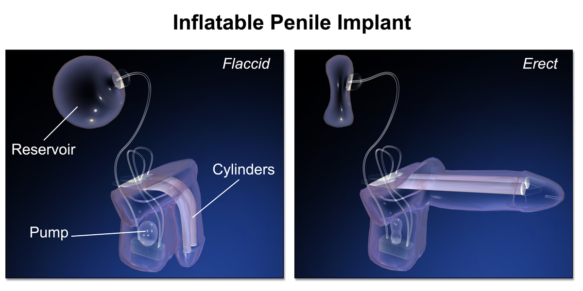 Penile_Implant.png