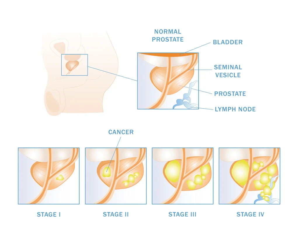 prostate cancer.webp