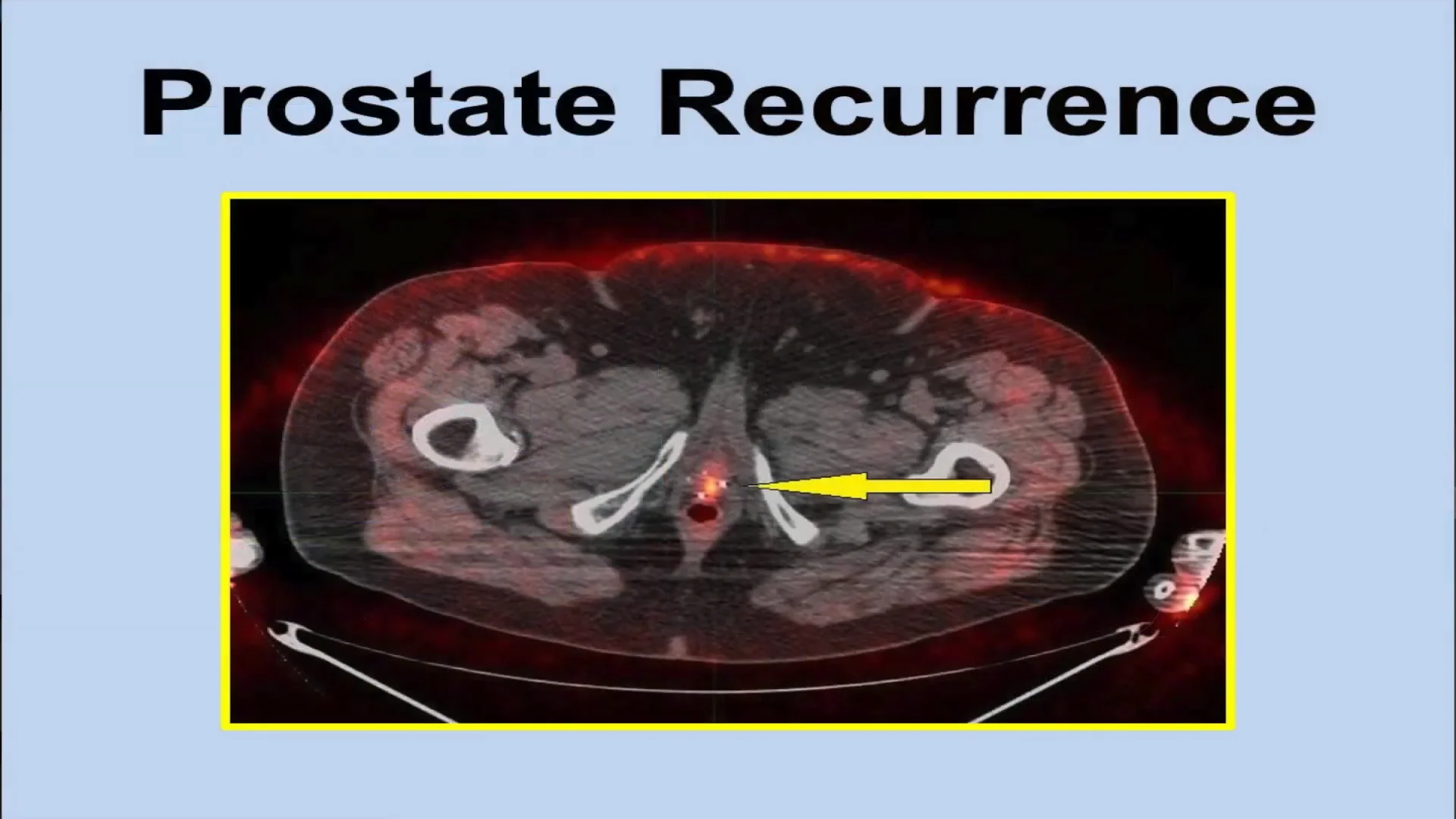 Imaging in Prostate Cancer - PET/CT | Excel Male TRT Forum