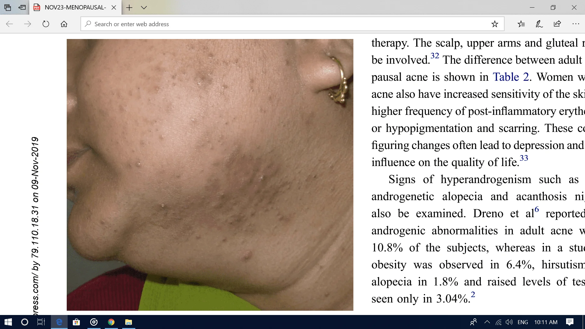 Menopausal Acne Challenges And Solutions Excel Male TRT Forum
