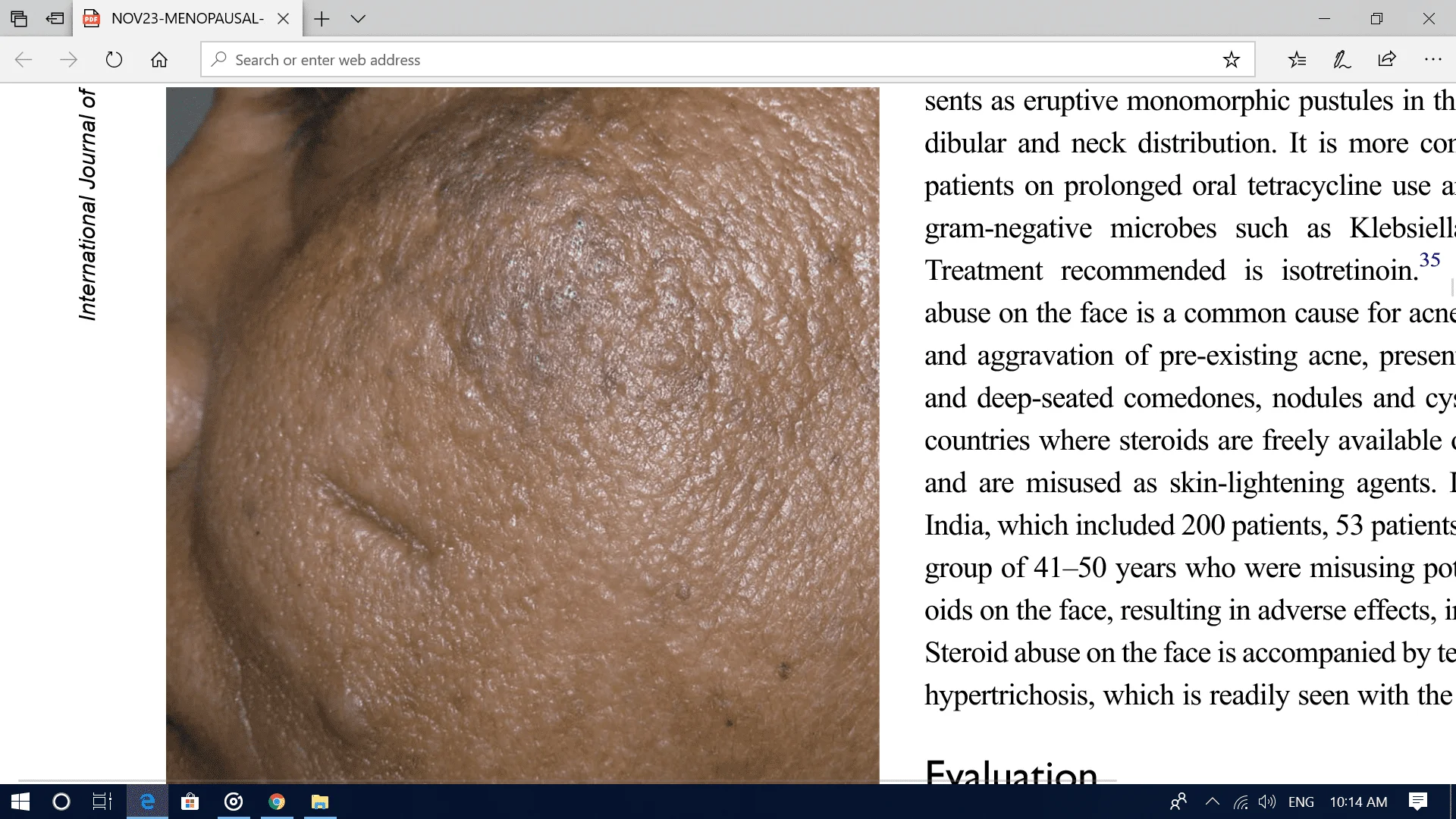 Menopausal Acne Challenges And Solutions Excel Male TRT Forum