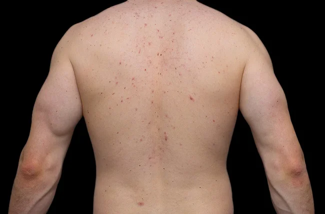 testosterone acne.webp