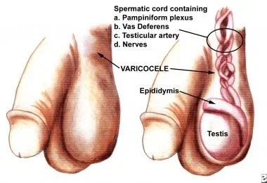 varicocele.webp