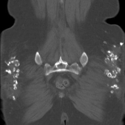 gluteal calcification following SQ injection.jpg