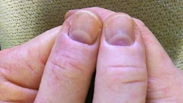 Discolored thumbnails.webp