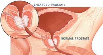 prostate bph.jpg