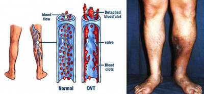 MVC-Miami-FL-March-is-DVT-Awareness-Month-Best-Vein-Doctor.png
