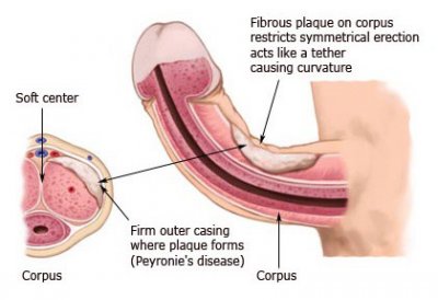 forum curvature penis penis stymulator ustny