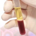 Platelet Rich Plasma Excelmale