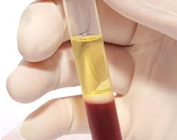 Platelet Rich Plasma Excelmale