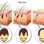 Testosterone and Hair Loss Excelmale