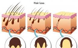 Testosterone and Hair Loss Excelmale