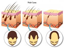 Testosterone and Hair Loss Excelmale