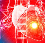 TRT and Stroke Excelmale