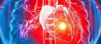 TRT and Stroke Excelmale