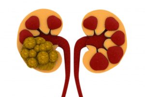 Kidney Stones Excelmale