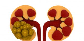 Kidney Stones Excelmale