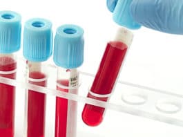 Blood Tests Excelmale