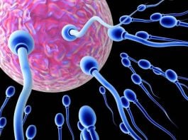 hyperspermia Male Infertility Exelmale