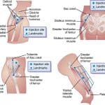 testosterone injection sites