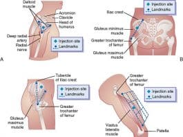 testosterone injection sites