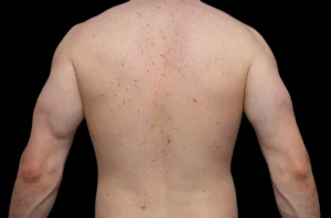 hormones skin