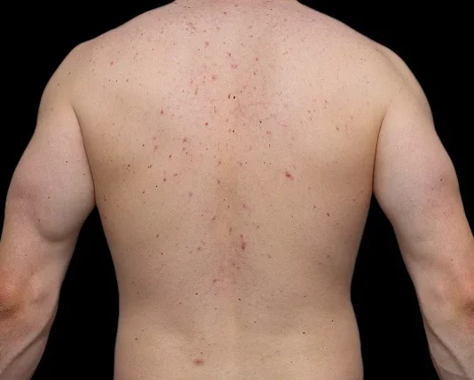 hormones skin